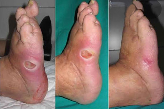 Diabetic Wounds / Ulcers
